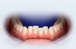 dientes amontonados o apiñados