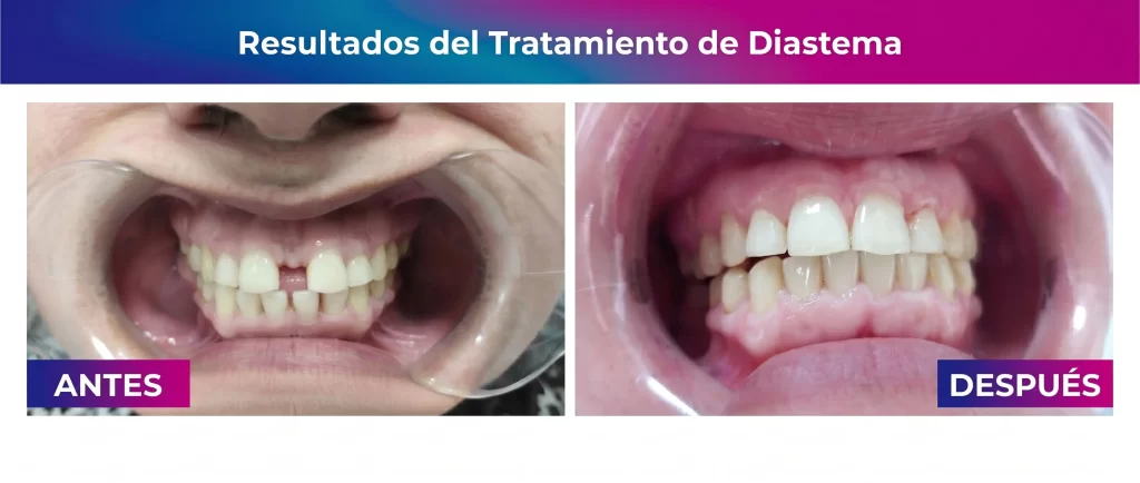 resultados de la ortodoncia invisible de soonline: diastema antes y despues