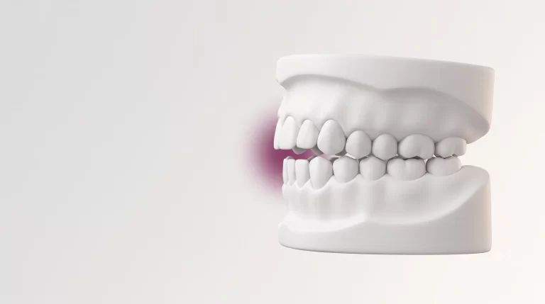 una dentadura con mordida abierta