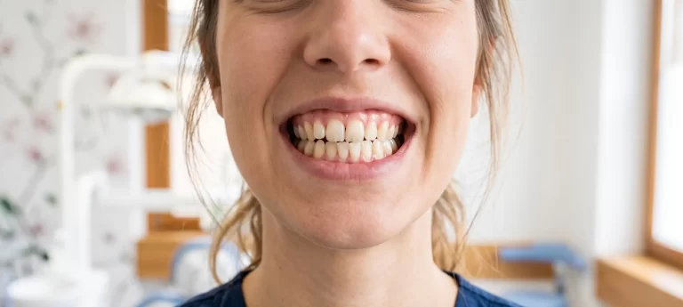 chica sonriendo mostrando mordida cruzada